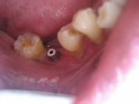 牙齿缺失了怎么办？