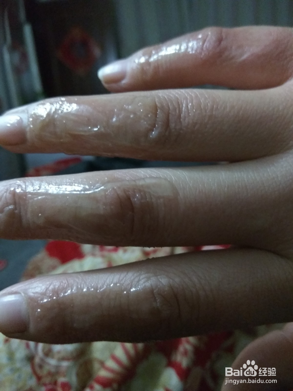 被烫伤的急救办法