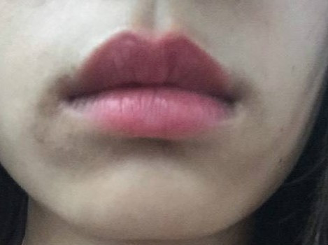 嘴角发黑去除小妙招有哪些