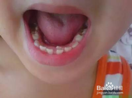 儿童换牙期间需要特别注意的事项
