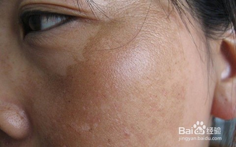 去斑正品品牌/祛斑知名产品/祛除雀斑正规机构