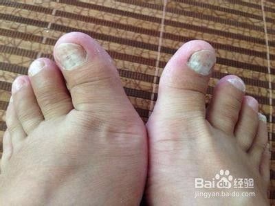 脚趾甲发白怎么回事 糖尿病症状表现有那些 百度经验