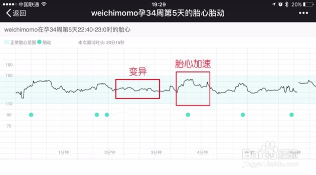 怎样及时发现胎儿缺氧