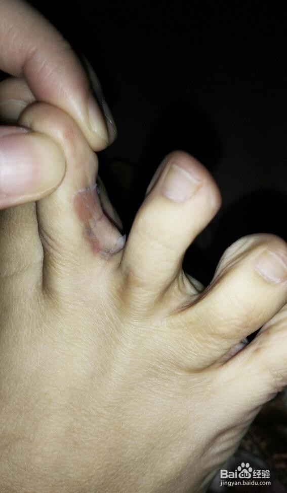 烂脚丫简单治疗法