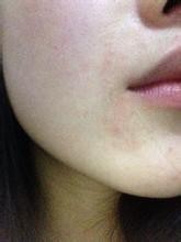 油性皮肤的特征及护理