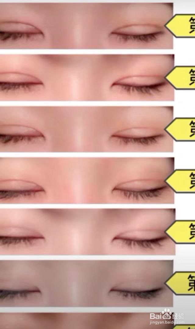 女生必知道的双眼皮术后注意事项
