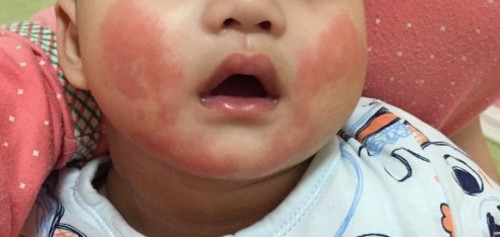 婴儿口水疹怎么办