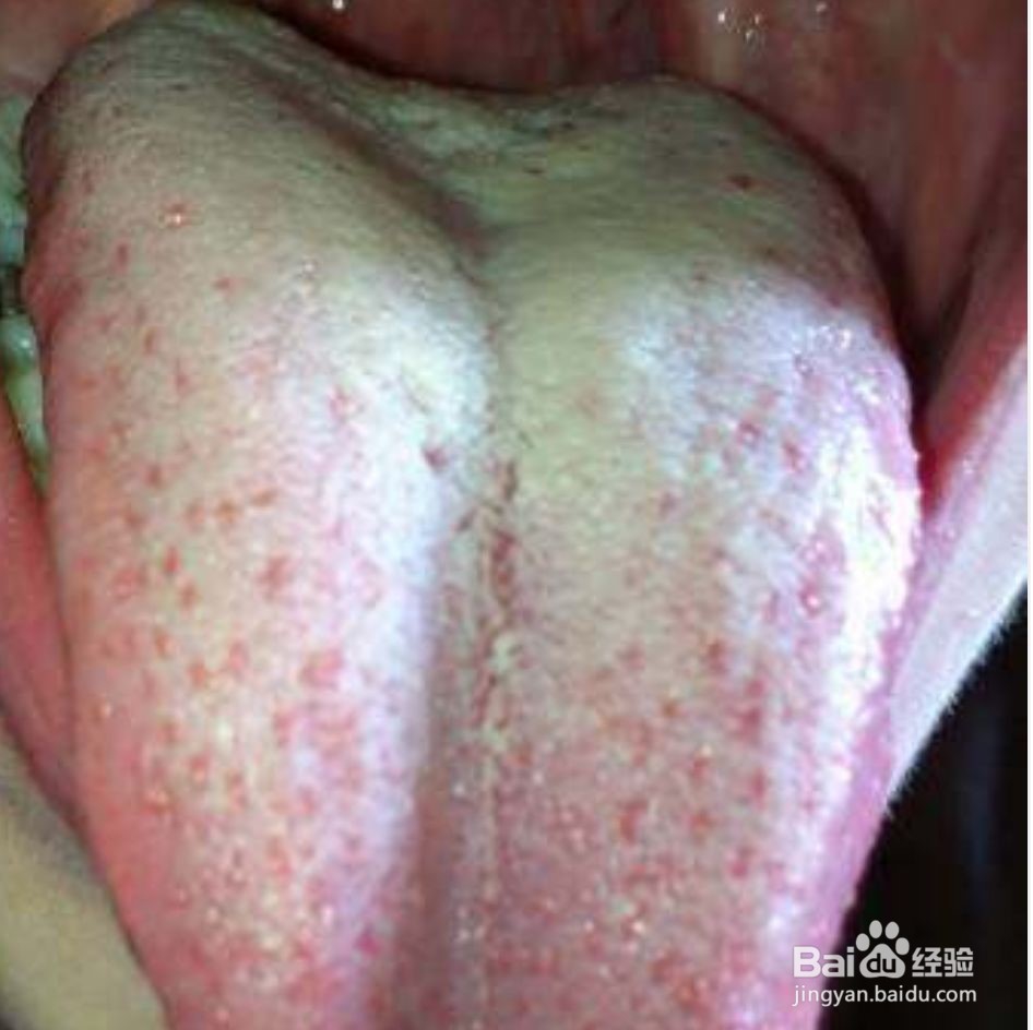 如何判断自己有没有湿气