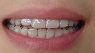 牙颌畸形的4种不良习惯