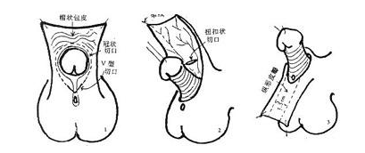 想了解小儿包茎的危害有哪些