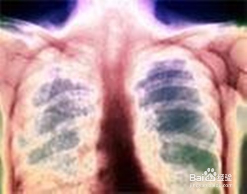 农民肺与肺结核有哪些互相鉴别？