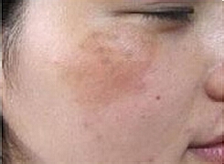 百莲凯教你怎么认清色斑类型及诱因