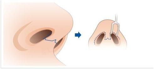 鼻窦炎的症状有哪些?