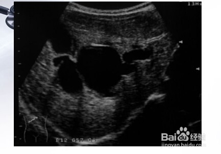 胆道系统几种常见疾病的影像图片。