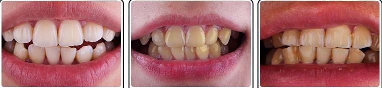 要让牙齿变白该怎么做