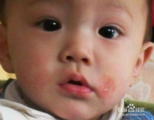 如何对新生宝宝的皮肤问题？