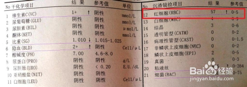 尿液报告单怎么看(干化学方法和镜检)