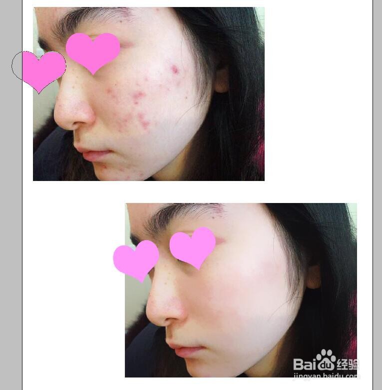 PS怎么去掉照片脸上的痘印斑点