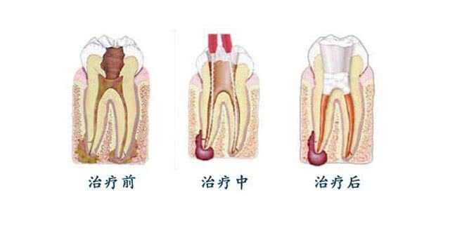 根管治疗是什么