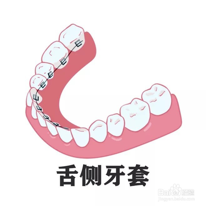 牙套类型图片