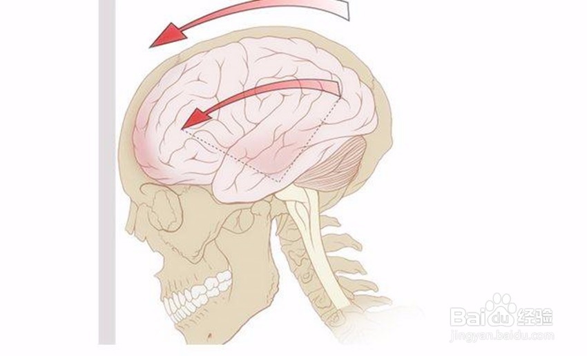 如何预防视网膜脱落