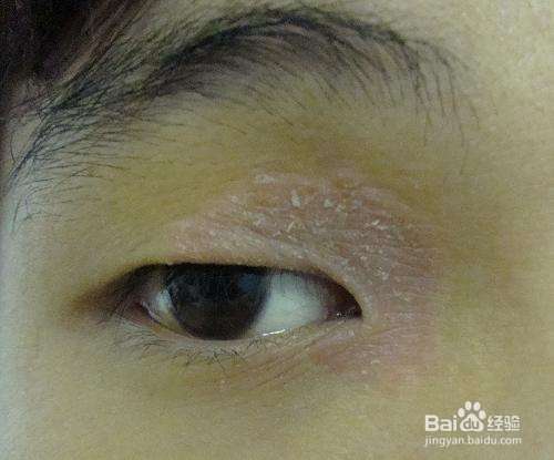 眼皮过敏痒起皮怎么办？这几天有点肿？