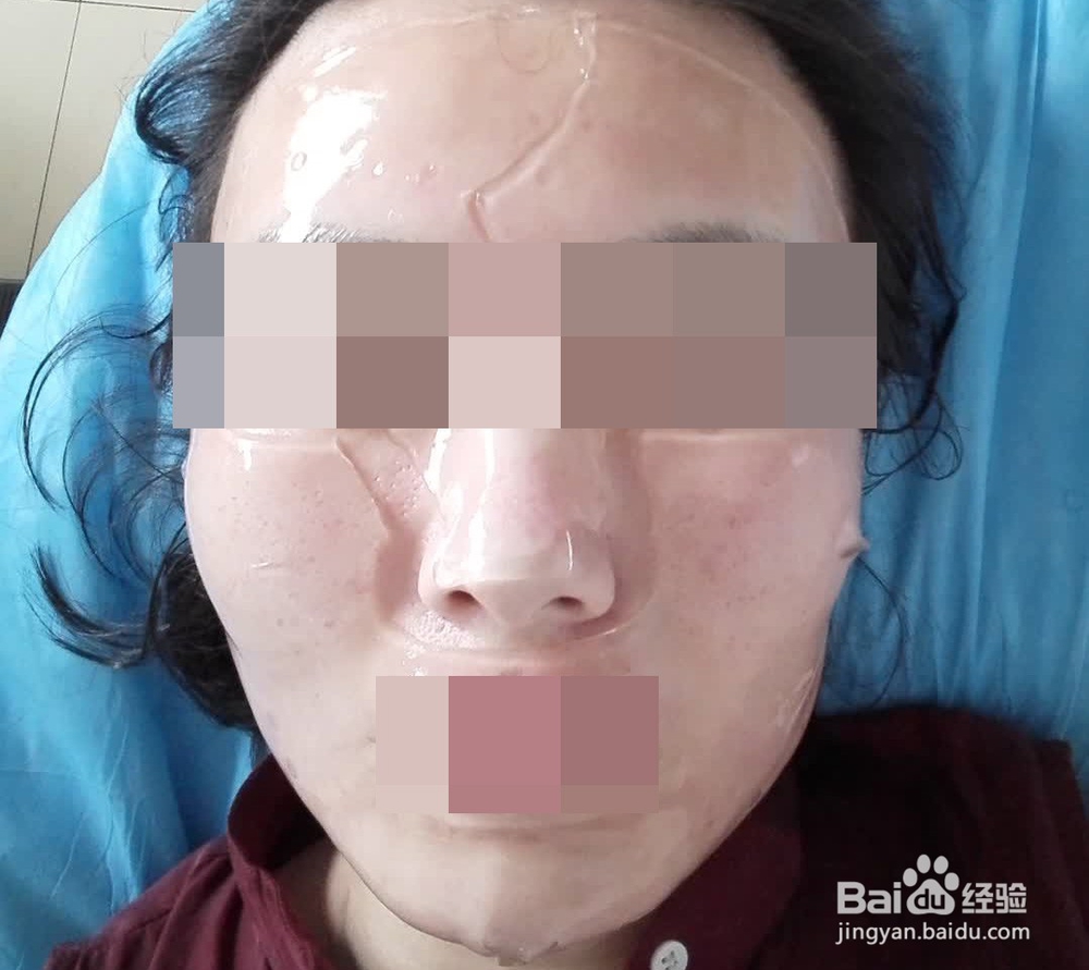 第一次做微针射频手术