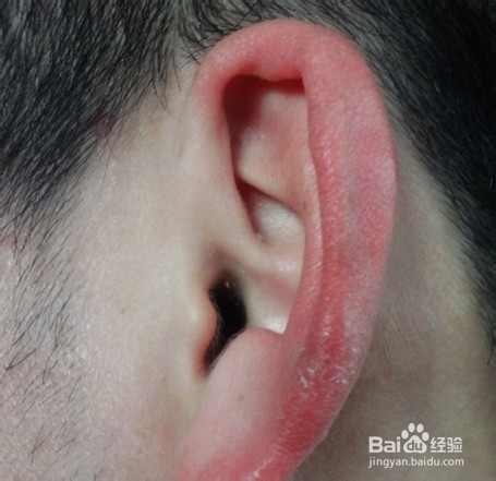 如何根治耳朵长冻疮?