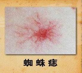 这几类人群需要警惕脂肪肝!