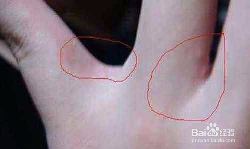 手上出现密密麻麻的小水泡怎么办