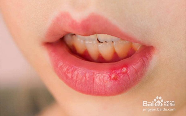 复发性口腔溃疡是什么