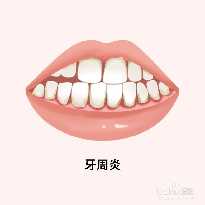 什么是牙周炎有什么危害