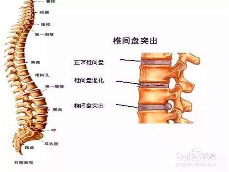 如何预防腰间盘突出