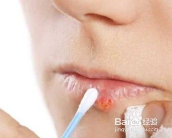 嘴唇疱疹怎么快速消除 百度经验 嘴唇疱疹怎么快速消除 百度经验