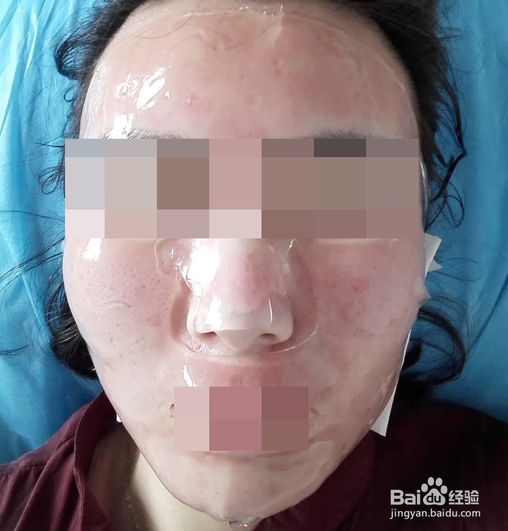 第一次做微针射频手术