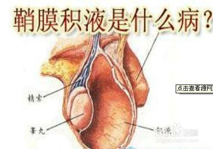 小儿鞘膜积液有哪些表现?