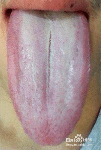 落枕了,脖子痛怎么办?