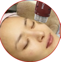 黄金射频微针的手术过程