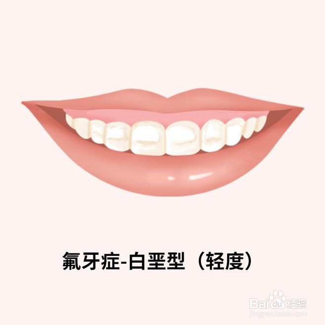 如何治疗氟牙症