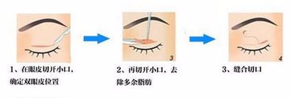双眼皮怎么做才不显假