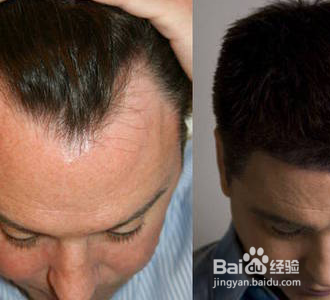 严重脱发怎么办?