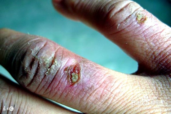 使用红外线灯可以治疗哪些疾病？