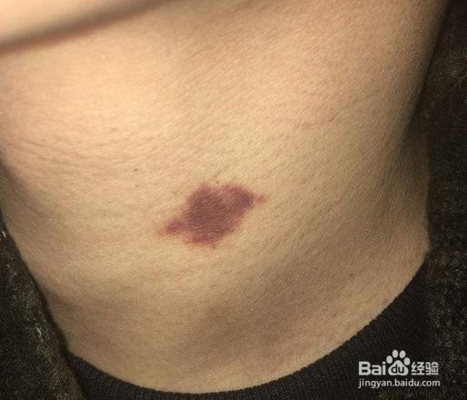 脖子吻痕怎么消除