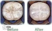 什么是窝沟封闭,为什么要做窝沟封闭?