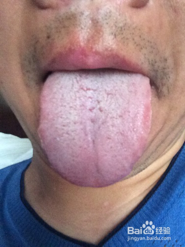舌苔发白是怎么回事 舌苔发白是什么原因呢 百度经验