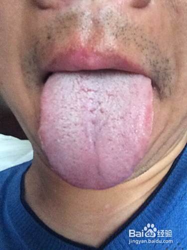 舌苔发白是怎么回事 舌苔发白是什么原因呢 百度经验 舌苔发白是怎么回事 舌苔发白是什么原因呢 百度经验