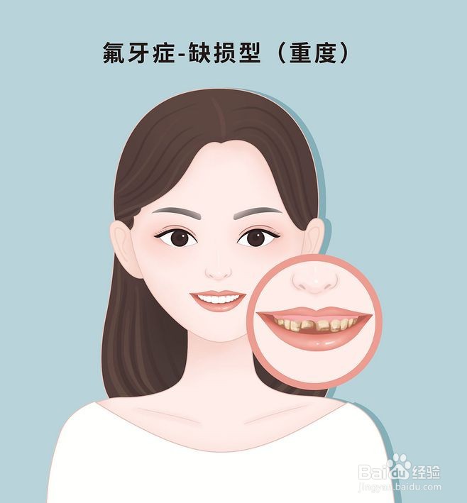 如何治疗氟牙症