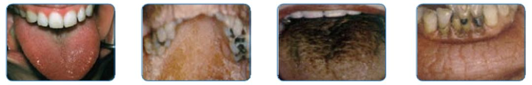 嘴巴好干好渴,饭都咽不下去,怎么办?