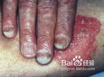给灰指甲患者的四个忠告