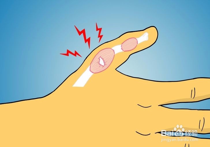 如何诊断拇指是否骨折?